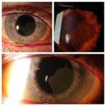 Blepharoplasty Complications Pictures (2)