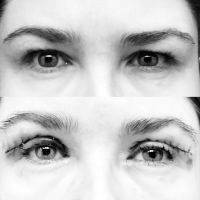 Blepharoplasty Recovery Day By Day By Dr Ronald Schuster