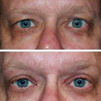 Chemosis After Eyelid Surgery For Men
