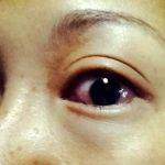 Chemosis Eye