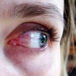 Chemosis Eye Causes