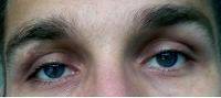 Doctor Keshav Magge Male Blepharoplasty Watery Eyes