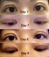 japanese eyelid surgery before and after