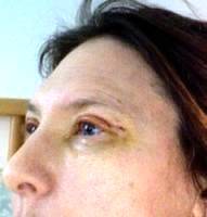 Eyelid Surgery Removes Puffiness And Bags Under The Eyes