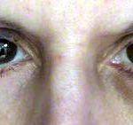 Eyelid Surgery Vision Impairment Patient Photos Results