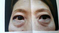 Give Asian Patients Natural-looking Double Eyelid Creases