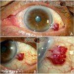 Infection Of The Eyelid (1)