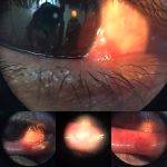 Infection Of The Eyelid (2)