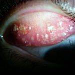 Infection Of The Eyelid (4)