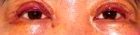 Lack A Natural Fold Just Above The Lashes In The Upper Eyelid