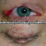 Lagophthalmos After Eyelid Surgery