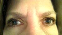 Loose Skin On Eyelids By Dr Thomas T. Le
