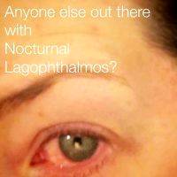 Nocturnal Lagophthalmos