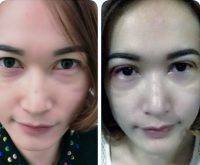 Plastic Surgery For Asian Eyelids