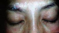Plastic Surgery On Asian Eyelids With A Natural Upper Lid Crease