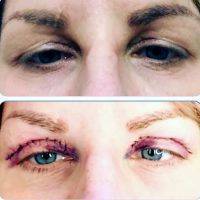 Removing Excess Skin And Pockets Of Fat From The Upper And Lower Eyelids