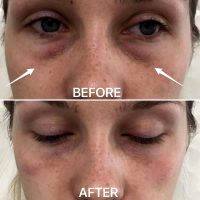 Before And After Blepharoplasty On Young Patients