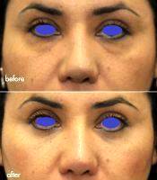Blepharoplasty In Young Patients Before And After