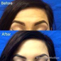 Botox Brow Lift Injection Sites Before And After
