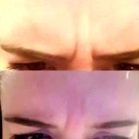 Botox Eyebrow Lift Pictures