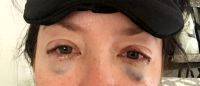 DOES INSURANCE COVER BLEPHAROPLASTY OR OTHER EYELID SURGERY