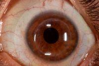 Dry Eye Syndrome After Blepharoplasty