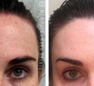 Errors Can Occur With Brow-lifts Done With Botox And Dysport