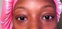 Eye Asymmetry After Blepharoplasty