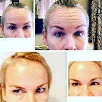 Eyebrow Lifts With Botox And Dysport