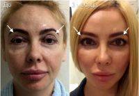 Facelift With Blepharoplasty Before And After