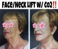 Facelift With Co2