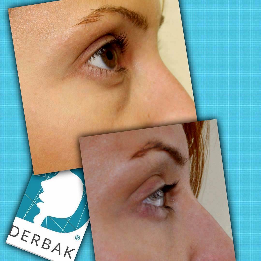 Laser Blepharoplasty Before And After 2 Eyelid Surgery Cost Photos Rewiews Qanda 