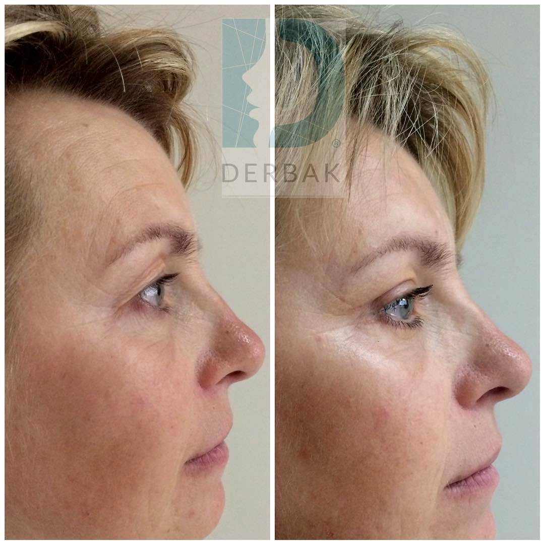 Laser Blepharoplasty Before And After (4) » Eyelid Surgery Cost