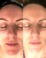 Laser Blepharoplasty For Eye Bags Before And After