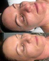 Laser Method Is A Modern And Efficient Method Of Smoothing Wrinkles Around The Eyes
