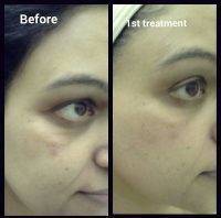 Laser Treatment For Wrinkles Before And After