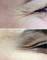 Lower Blepharoplasty Wrinkles