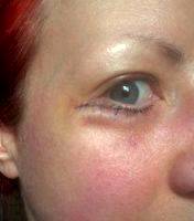Medical Insurance Companies Rarely Pay For Cosmetic Blepharoplasty