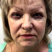 Most Surgeons Recommend That Dry Eye Suffers Should Not Consider Blepharoplasty At All