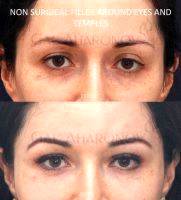 Nonsurgical Filler For Asymmetry Eyes