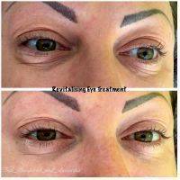 Revitalising To Remove Eyelid Wrinkles