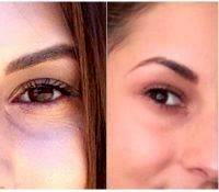 Upper Blepharoplasty Young Patient
