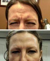 What Is A Botox Brow Lift