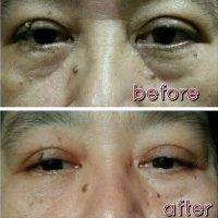 Wrinkle Reduction And Prevention Treatments