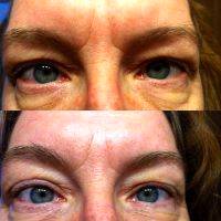 Wrinkles After Lower Blepharoplasty