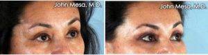 33 Year Old Woman Treated With Eyelid Surgery (upper And Lower Lids) By Dr. John Mesa, MD, New York Plastic Surgeon