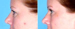 35 Year Old Female Treated With Upper And Lower Blepharoplasty With Dr. Dan Mills, MD, Orange County Plastic Surgeon