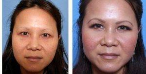 39 Year Old Woman Treated With Asian Eyelid Surgery By Dr. Andrew Choi, MD, Los Angeles Facial Plastic Surgeon