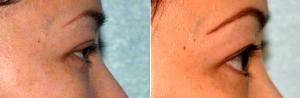 40 Year Old Female With Doctor Joseph W. Aguiar, MD, Tampa Plastic Surgeon