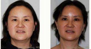 46 Year Old Woman Treated With Upper Eyelid Lift With Dr Chia Jen Lynn Chung, MD, Puyallup Plastic Surgeon